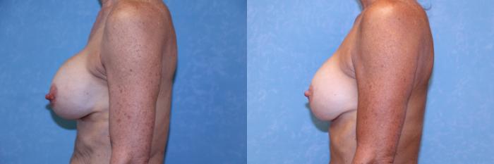Before & After Complex Cases Case 585 Left Side View in Toledo, Ohio