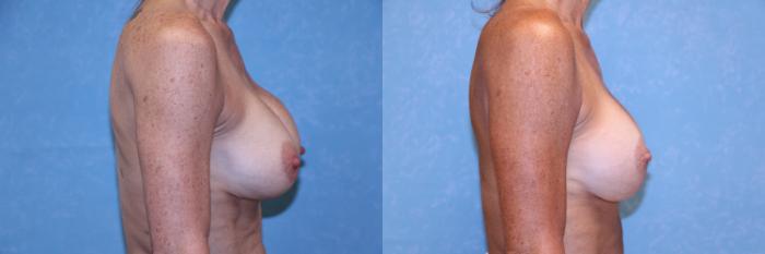 Before & After Complex Cases Case 585 Right Side View in Toledo, Ohio