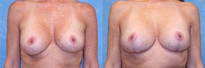 Before & After Complex Cases Case 589 Front View in Toledo, Ohio