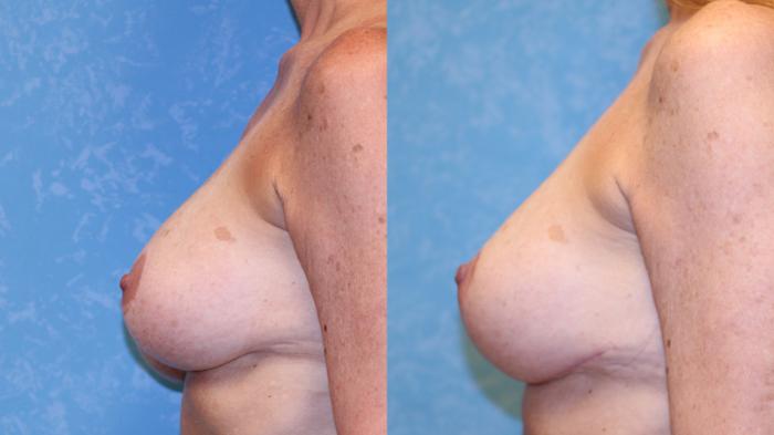 Before & After Complex Cases Case 589 Left Side View in Toledo, Ohio
