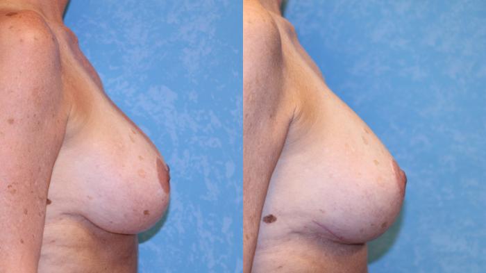 Before & After Complex Cases Case 589 Right Side View in Toledo, Ohio