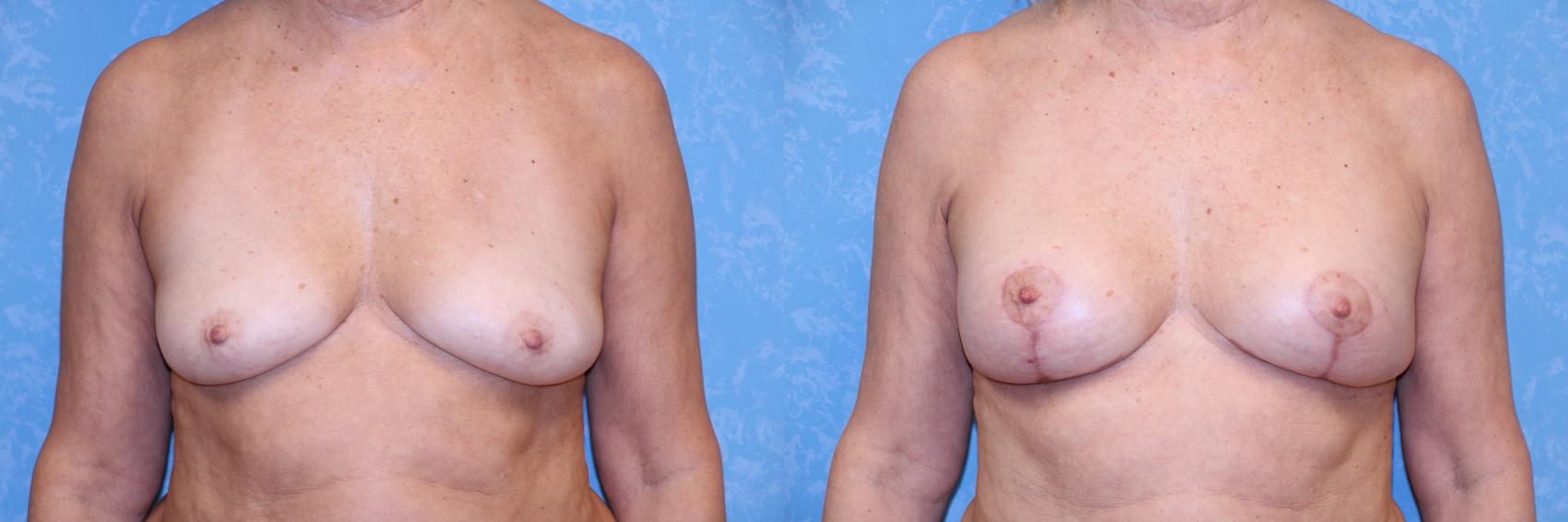 Before & After Complex Cases Case 607 Front View in Toledo, Ohio