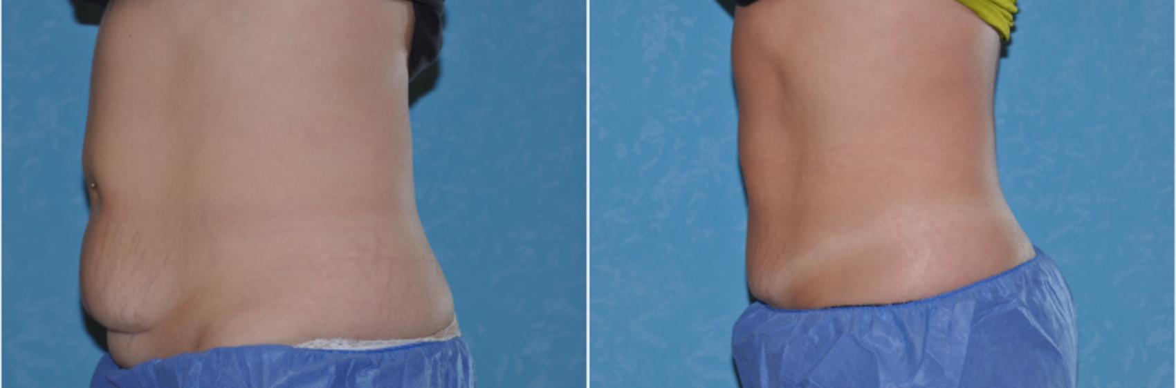 Before & After CoolSculpting® Case 104 View #1 View in Toledo, Ohio