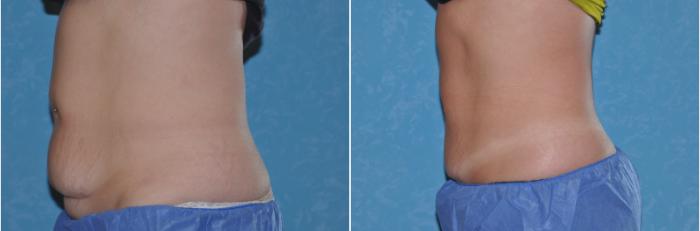 Before & After CoolSculpting® Case 104 View #1 View in Toledo, Ohio