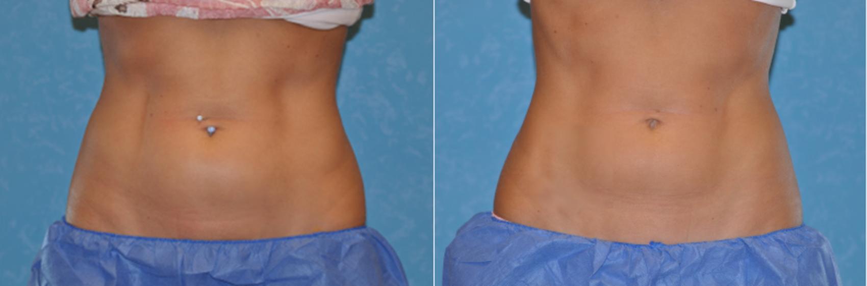 Before & After CoolSculpting® Case 106 View #1 View in Toledo, Ohio