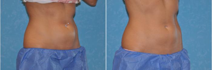 Before & After CoolSculpting® Case 106 View #2 View in Toledo, Ohio