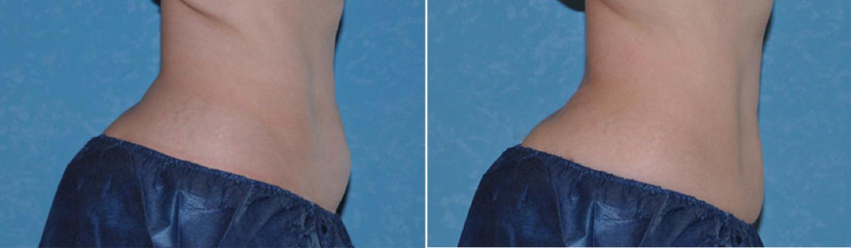 Before & After CoolSculpting® Case 107 View #1 View in Toledo, Ohio