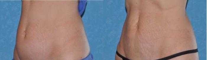 Before & After CoolSculpting® Case 110 View #1 View in Toledo, Ohio