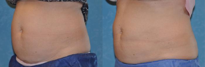 Before & After CoolSculpting® Case 150 View #1 View in Toledo, Ohio