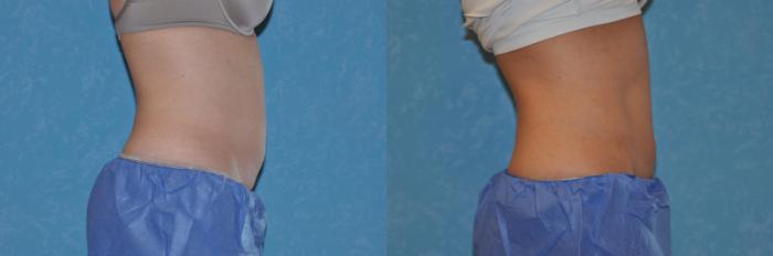 Before & After CoolSculpting® Case 162 View #2 View in Toledo, Ohio