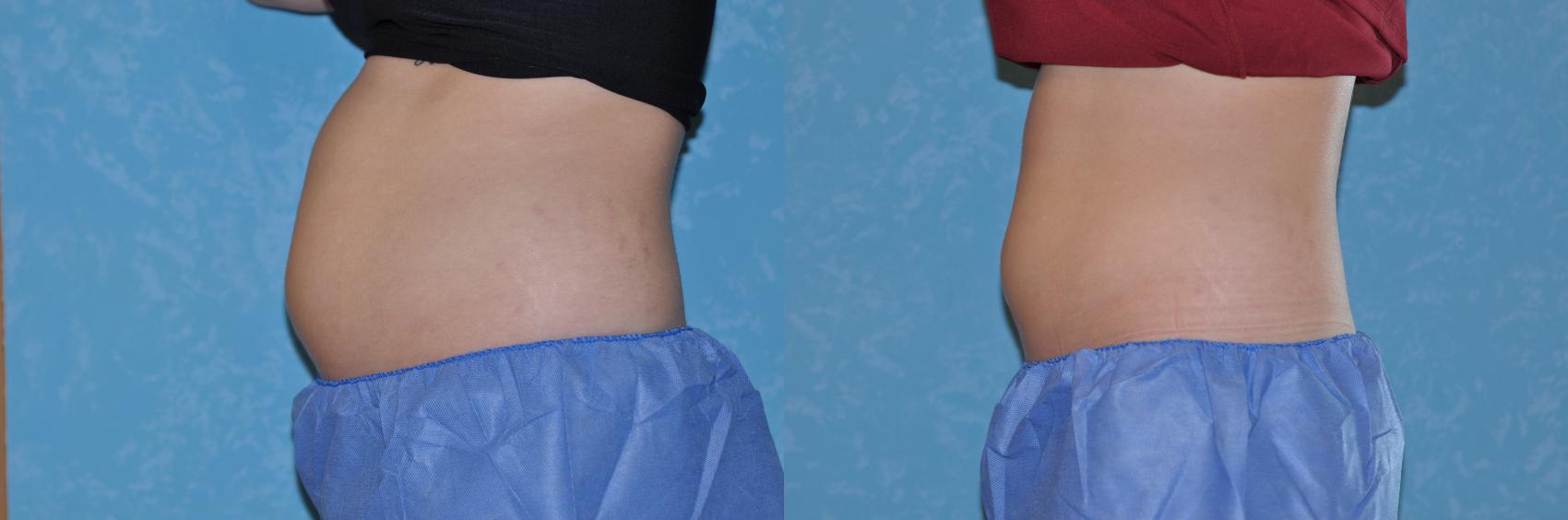 Before & After CoolSculpting® Case 168 View #1 View in Toledo, Ohio