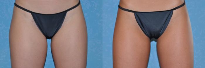 Before & After CoolSculpting® Case 169 View #1 View in Toledo, Ohio