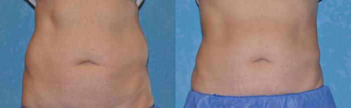 Before & After CoolSculpting® Case 176 View #1 View in Toledo, Ohio