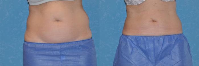 Before & After CoolSculpting® Case 177 View #1 View in Toledo, Ohio