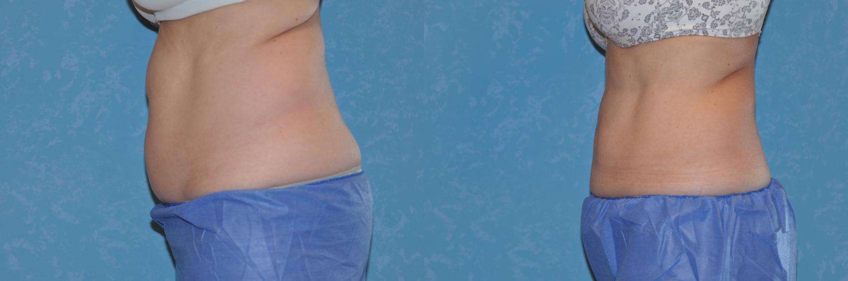 Before & After CoolSculpting® Case 177 View #2 View in Toledo, Ohio