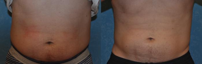 Before & After CoolSculpting® Case 313 View #1 View in Toledo, Ohio