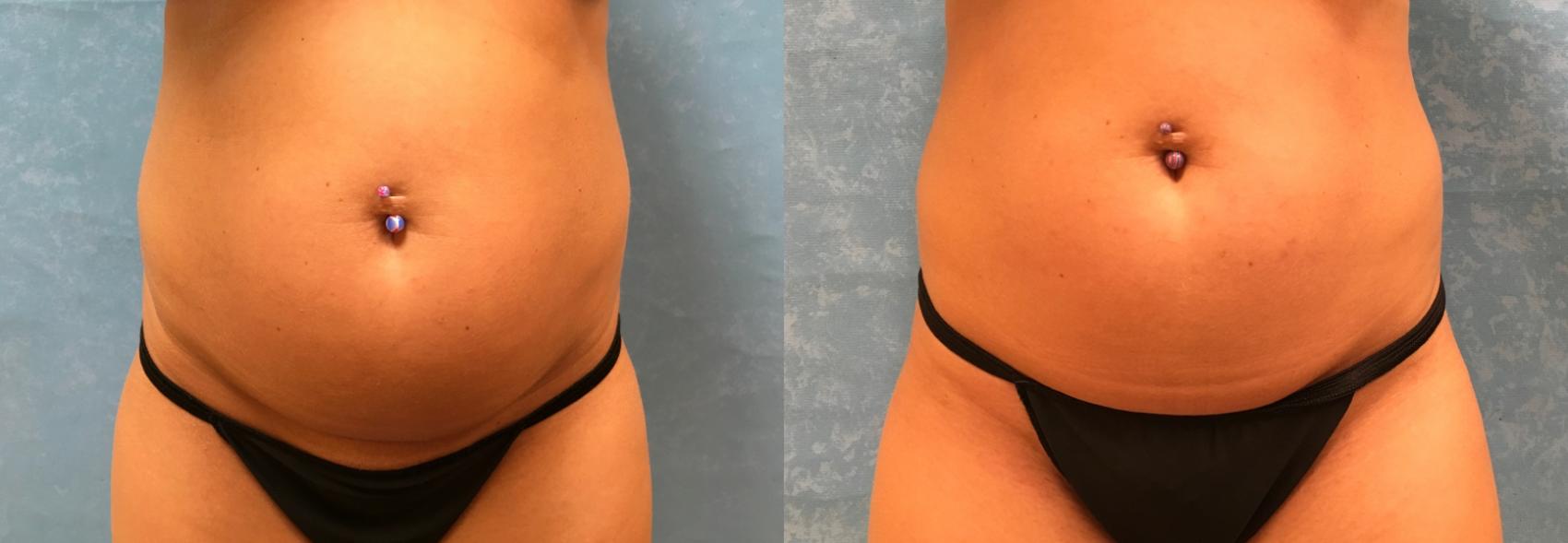 Before & After CoolSculpting® Case 314 View #1 View in Toledo, Ohio