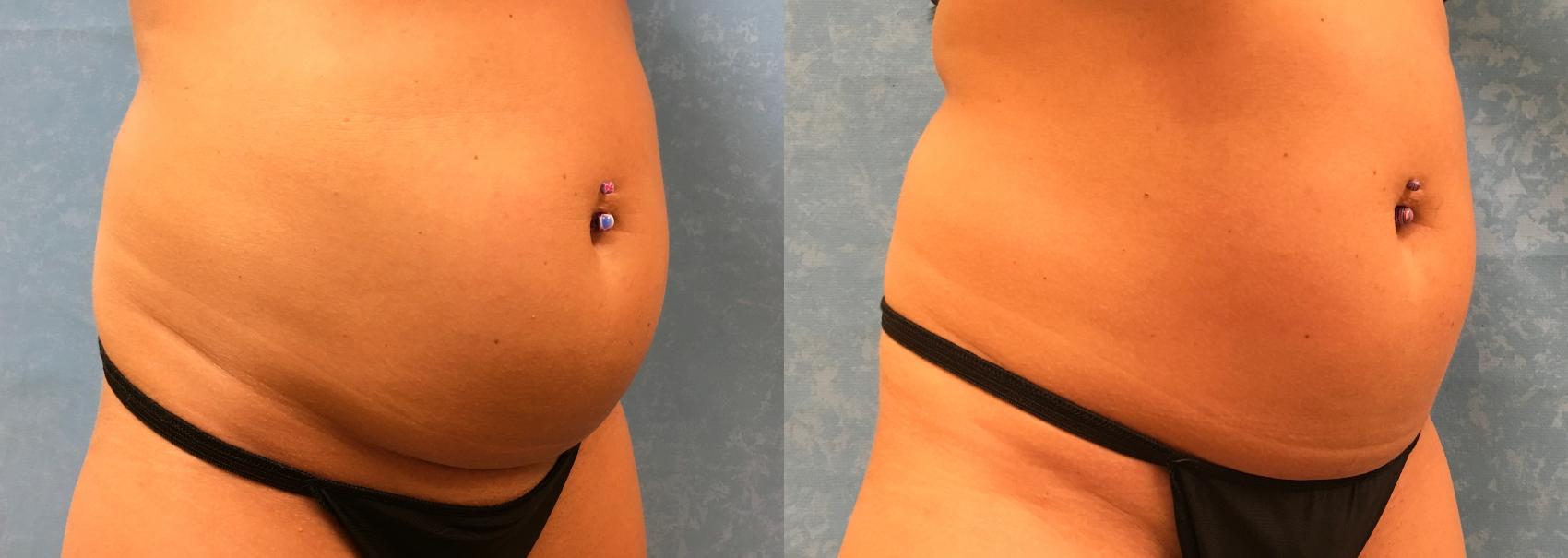 Before & After CoolSculpting® Case 314 View #2 View in Toledo, Ohio