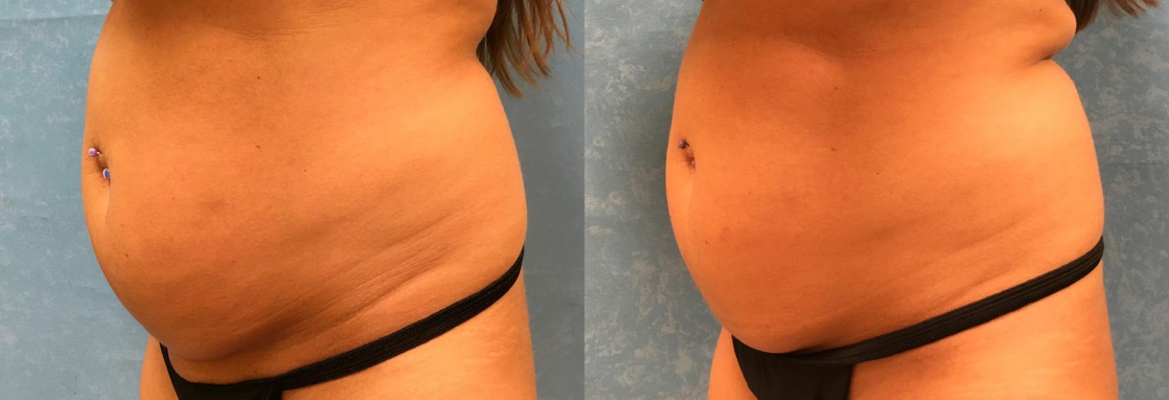 Before & After CoolSculpting® Case 314 View #3 View in Toledo, Ohio