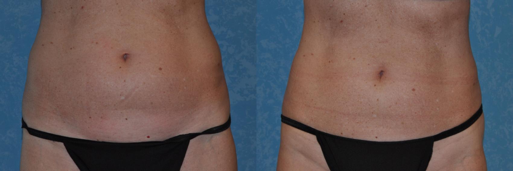 Before & After CoolSculpting® Case 315 View #1 View in Toledo, Ohio
