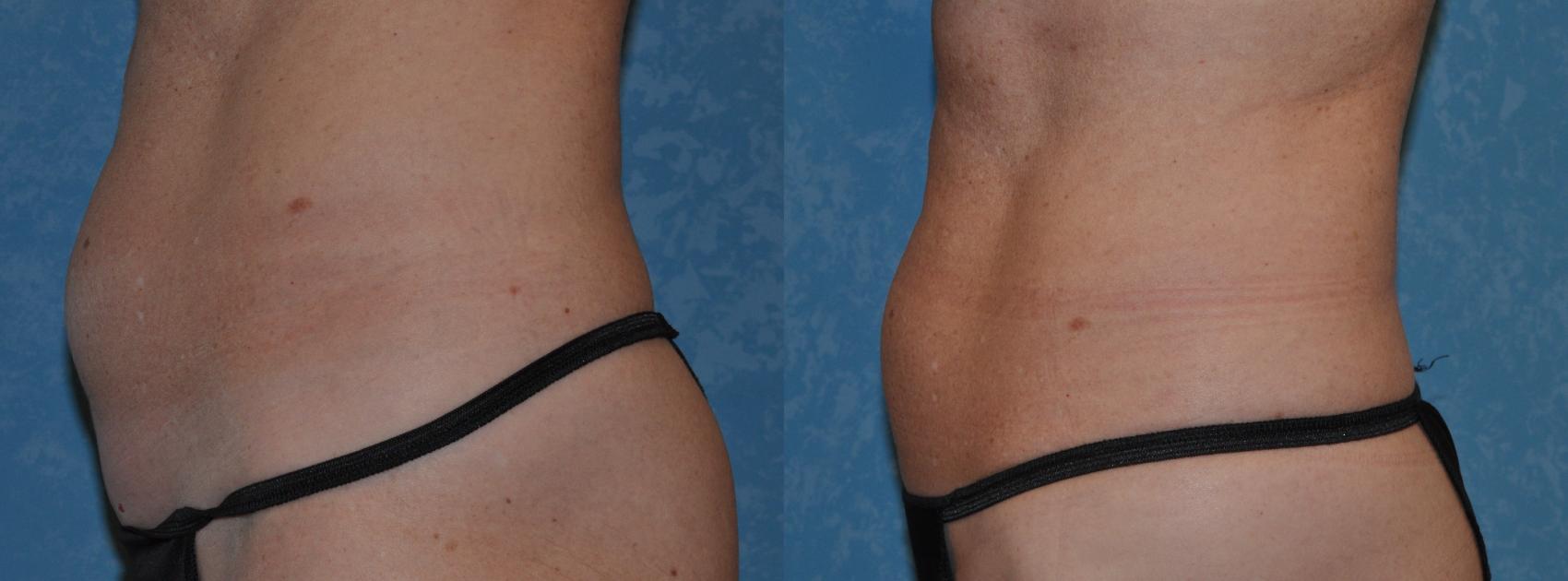Before & After CoolSculpting® Case 315 View #2 View in Toledo, Ohio