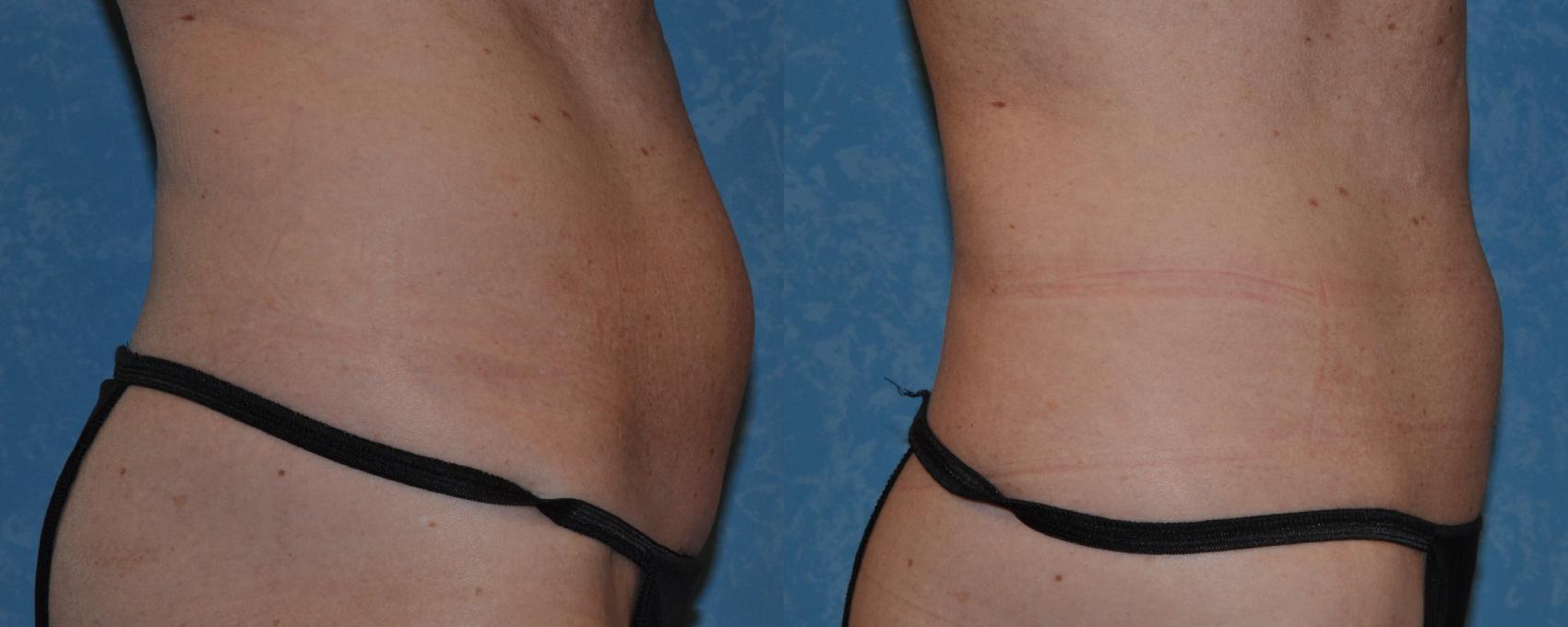 Before & After CoolSculpting® Case 315 View #3 View in Toledo, Ohio