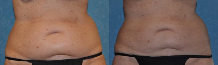 Before & After CoolSculpting® Case 317 View #1 View in Toledo, Ohio