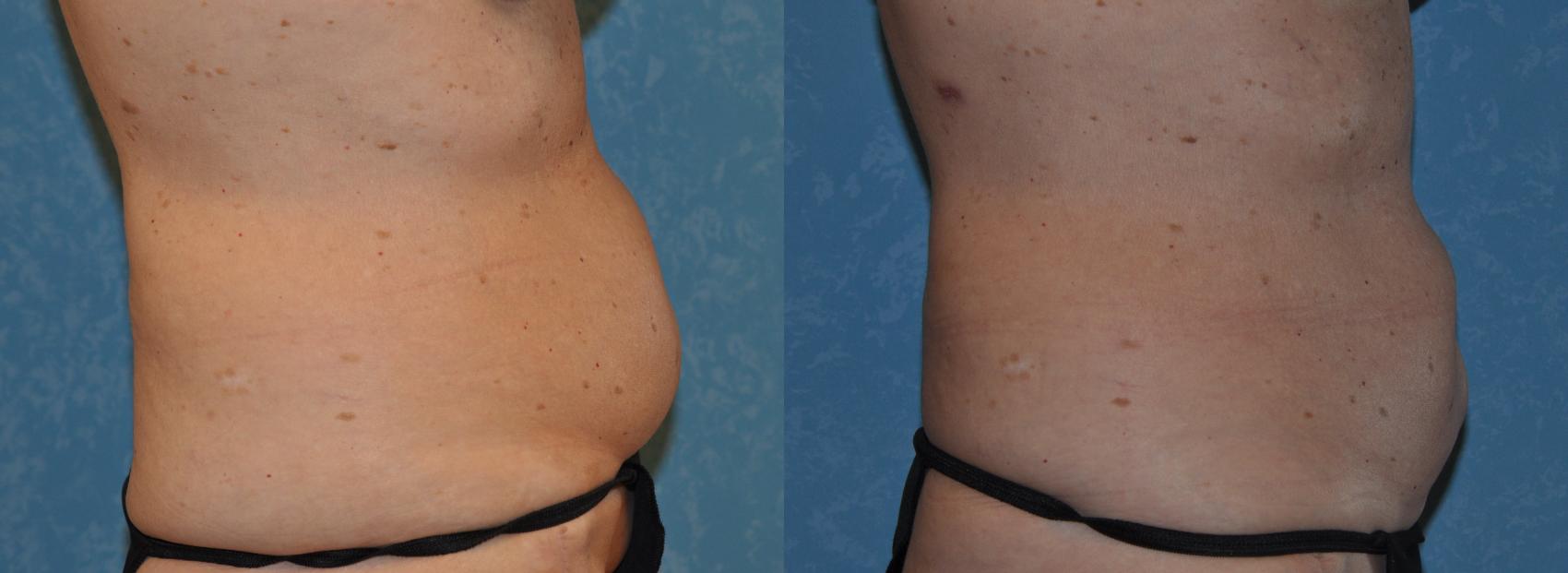 Before & After CoolSculpting® Case 317 View #2 View in Toledo, Ohio