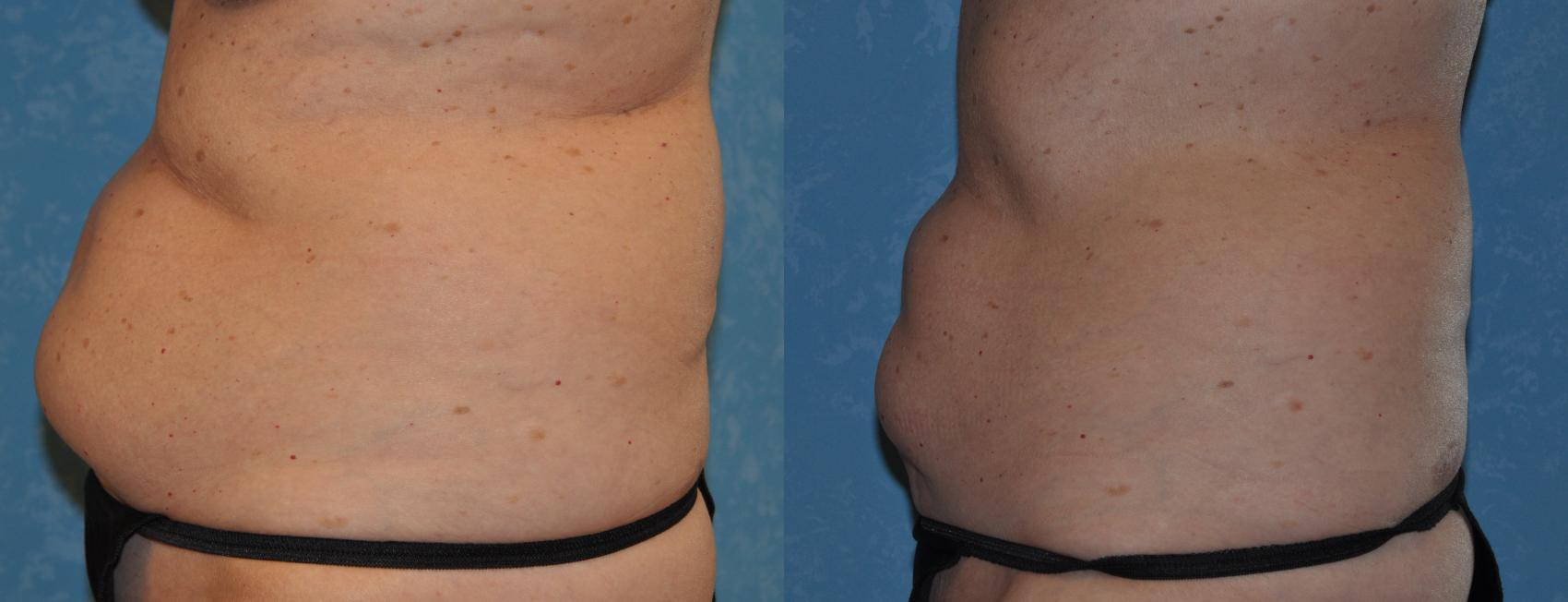 Before & After CoolSculpting® Case 317 View #3 View in Toledo, Ohio