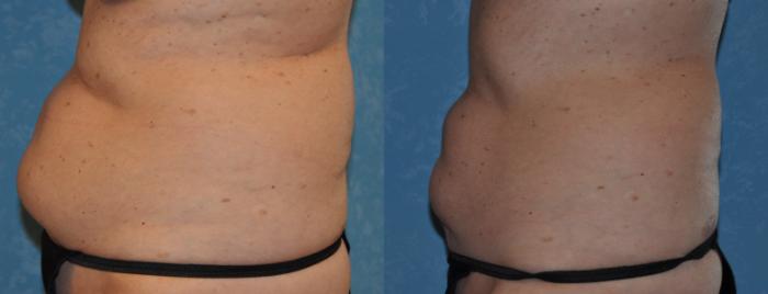 Before & After CoolSculpting® Case 317 View #3 View in Toledo, Ohio