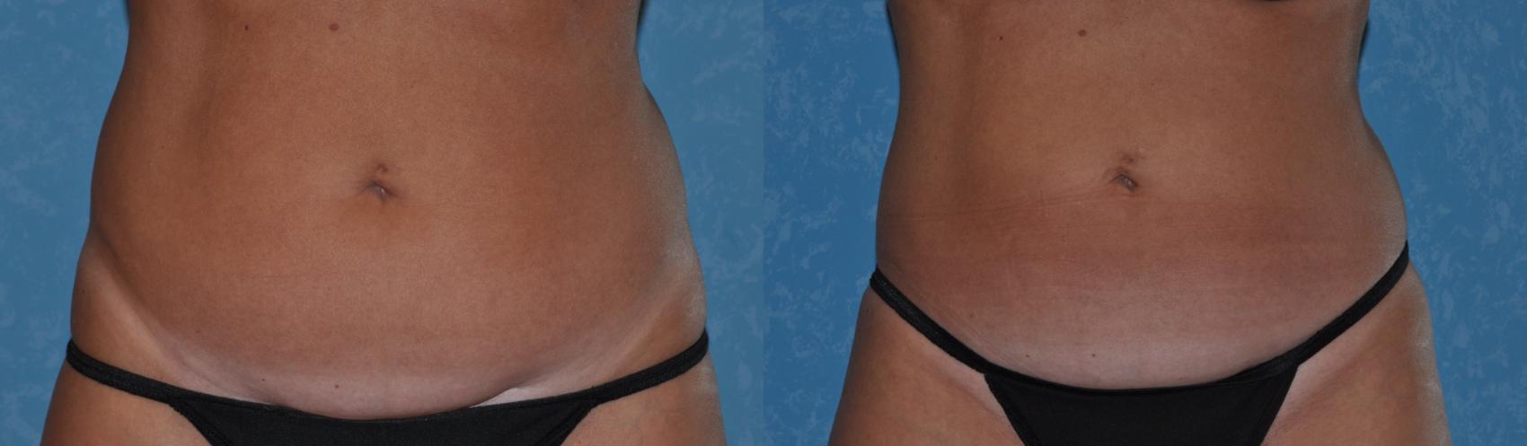 Before & After CoolSculpting® Case 318 View #1 View in Toledo, Ohio