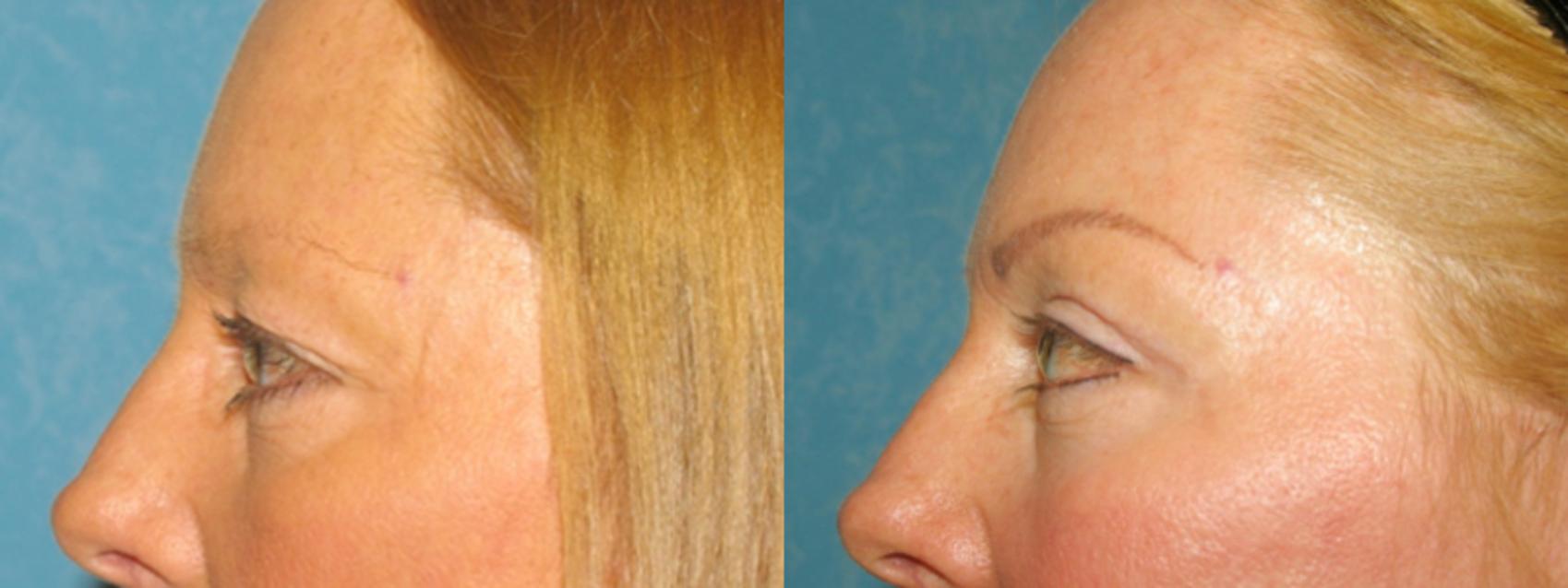 Before & After Eyelid Lift Case 113 View #1 View in Toledo, Ohio