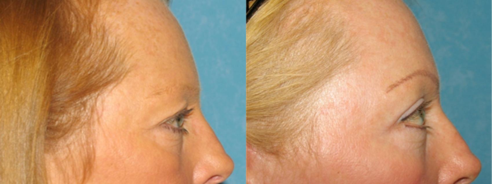 Before & After Eyelid Lift Case 113 View #2 View in Toledo, Ohio
