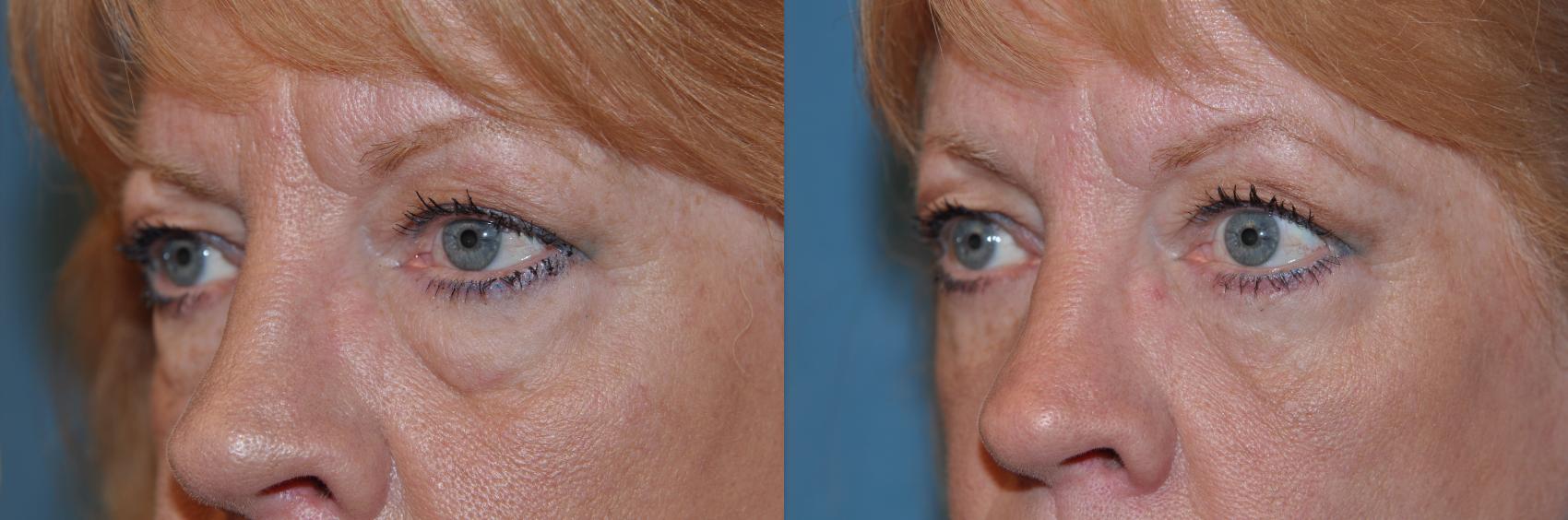 Before & After Eyelid Lift Case 130 View #1 View in Toledo, Ohio