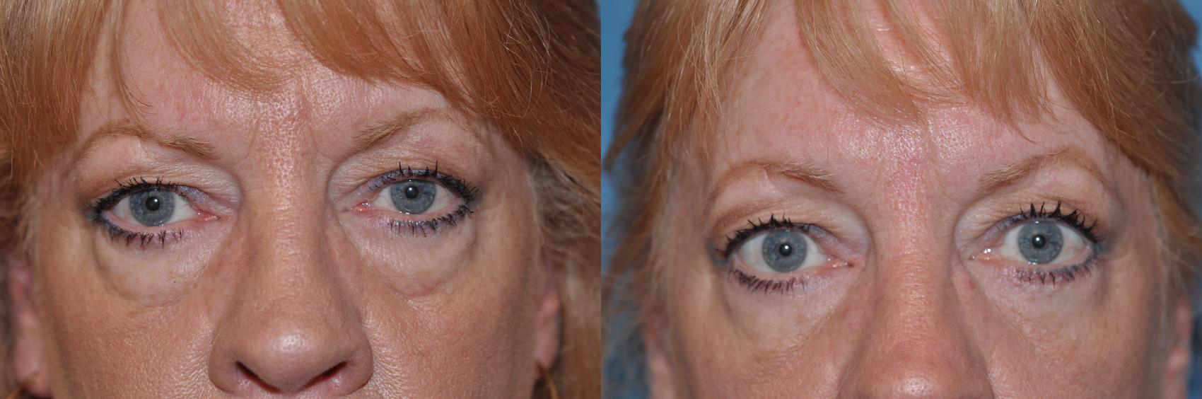 Before & After Eyelid Lift Case 130 View #2 View in Toledo, Ohio