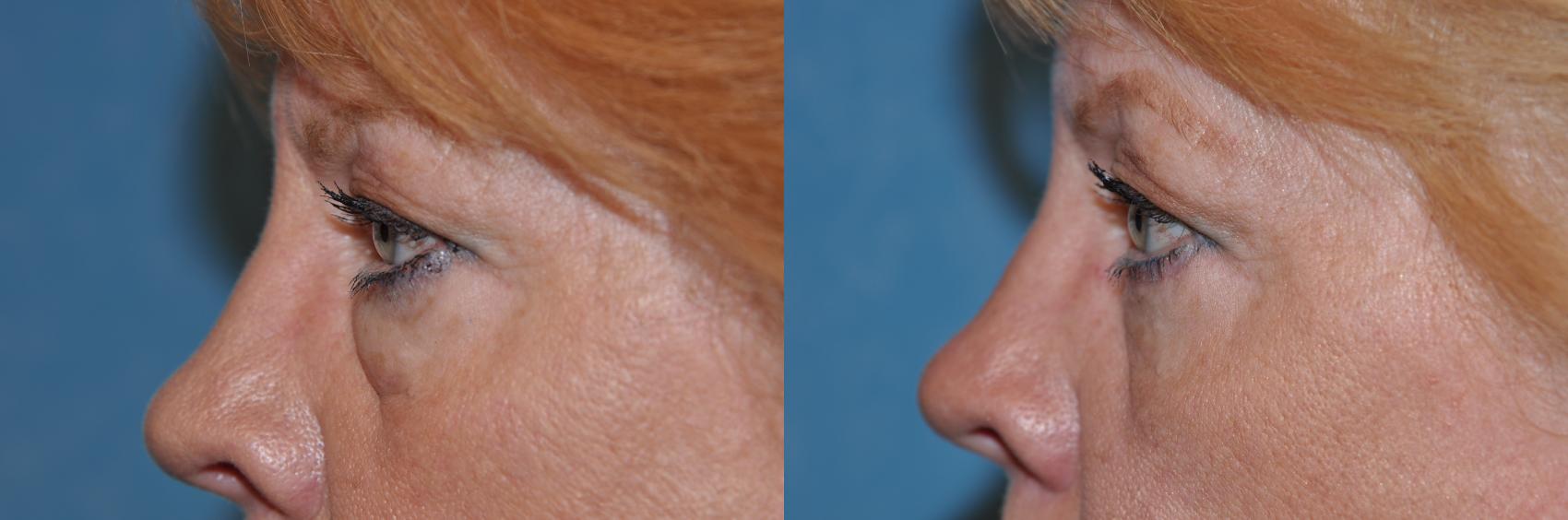 Before & After Eyelid Lift Case 130 View #3 View in Toledo, Ohio