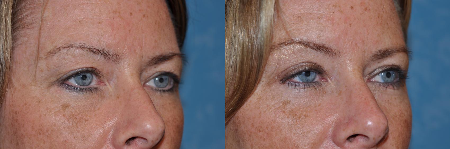 Before & After Eyelid Lift Case 131 View #1 View in Toledo, Ohio