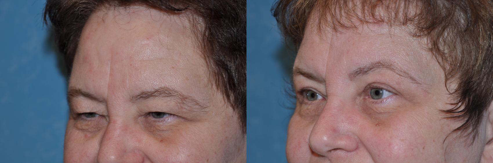 Before & After Eyelid Lift Case 132 View #1 View in Toledo, Ohio