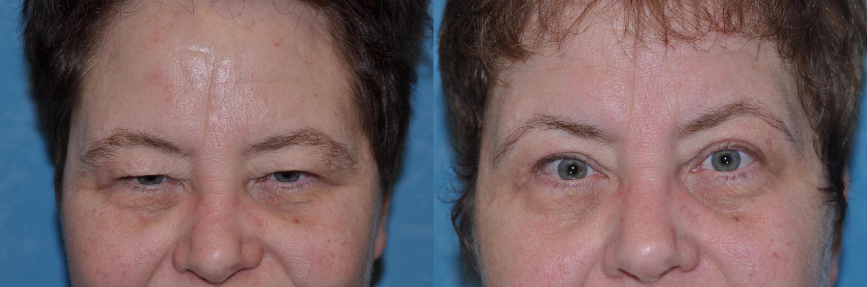 Before & After Eyelid Lift Case 132 View #2 View in Toledo, Ohio
