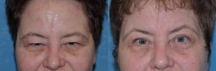 Before & After Eyelid Lift Case 132 View #2 View in Toledo, Ohio