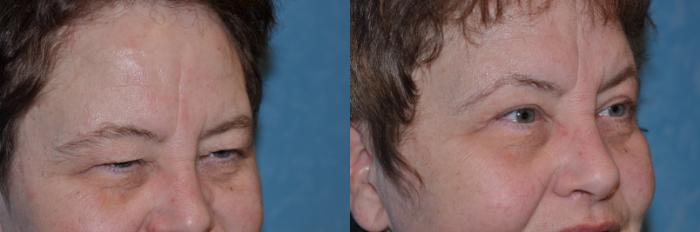 Before & After Eyelid Lift Case 132 View #3 View in Toledo, Ohio