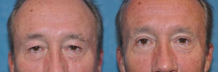 Before & After Eyelid Lift Case 228 View #1 View in Toledo, Ohio
