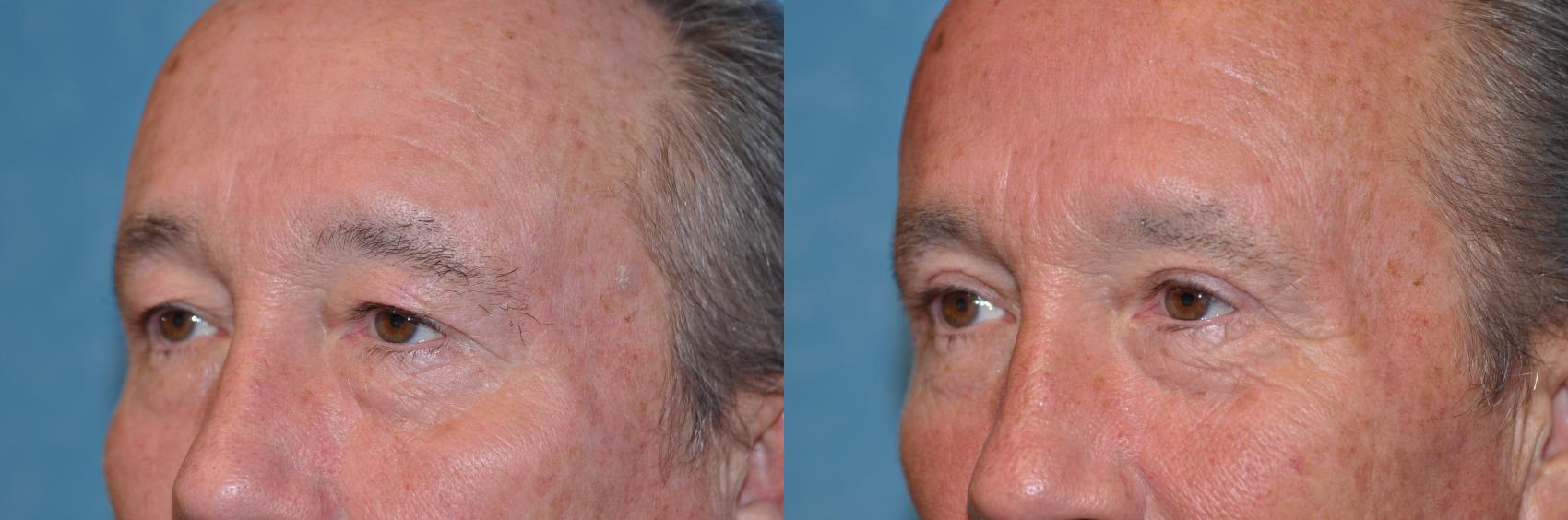 Before & After Eyelid Lift Case 228 View #2 View in Toledo, Ohio