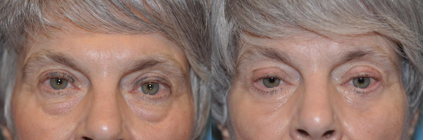 Before & After Eyelid Lift Case 230 View #1 View in Toledo, Ohio