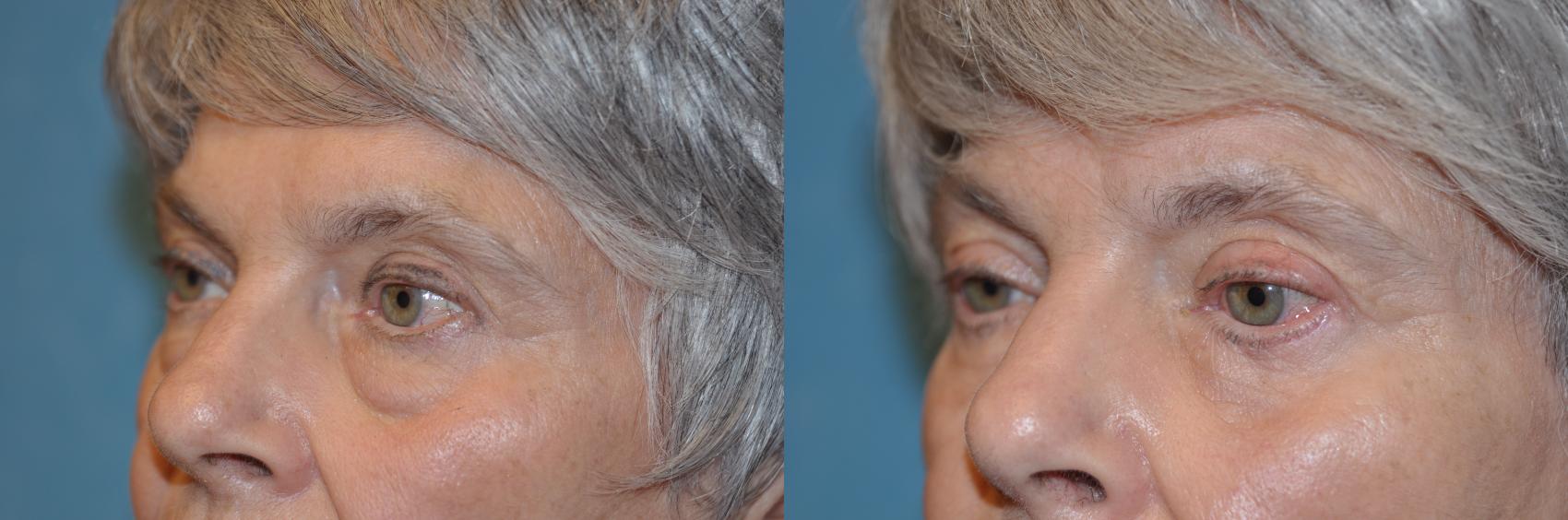 Before & After Eyelid Lift Case 230 View #2 View in Toledo, Ohio