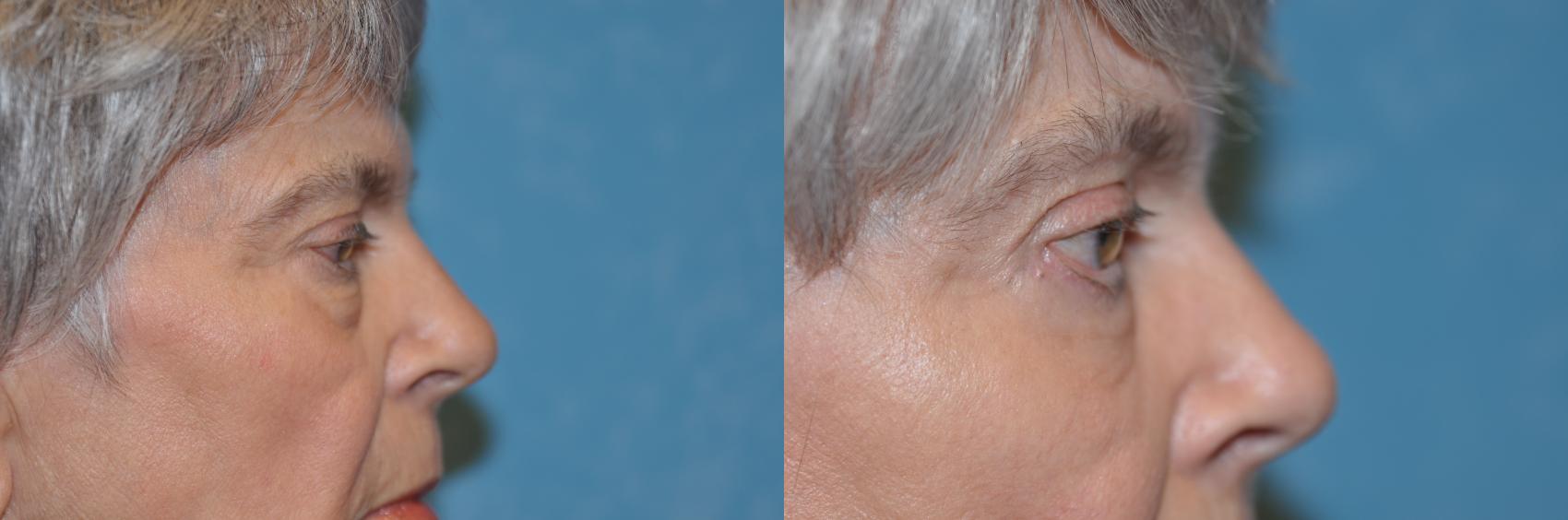 Before & After Eyelid Lift Case 230 View #3 View in Toledo, Ohio