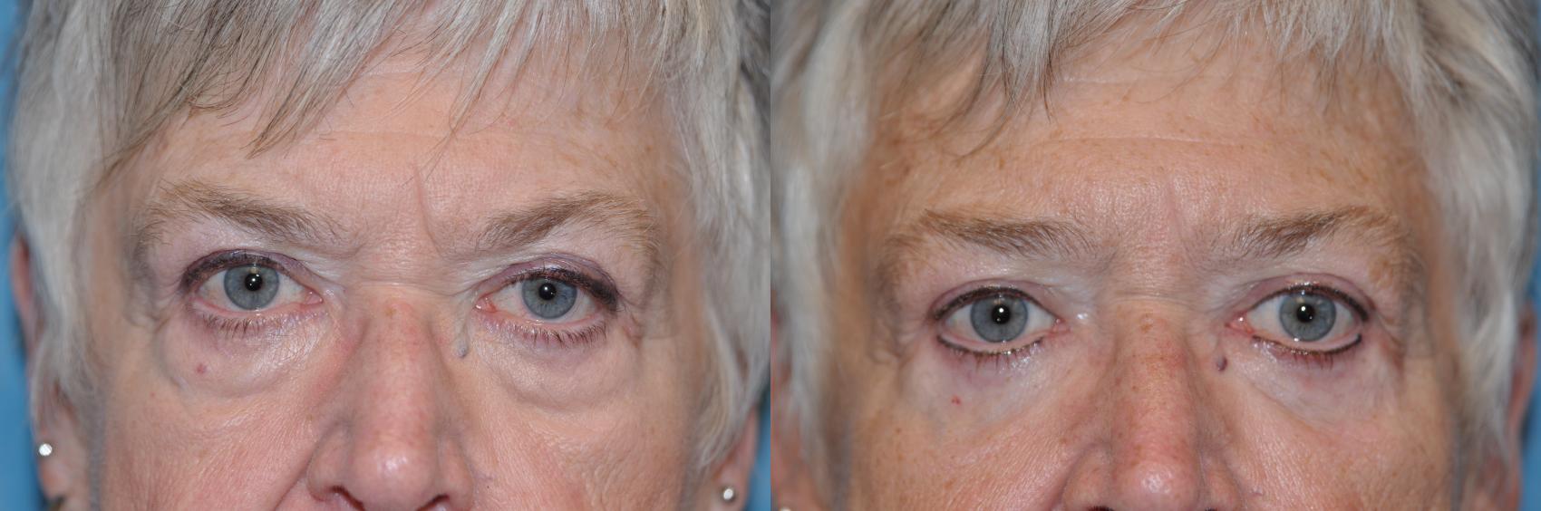 Before & After Eyelid Lift Case 251 View #1 View in Toledo, Ohio