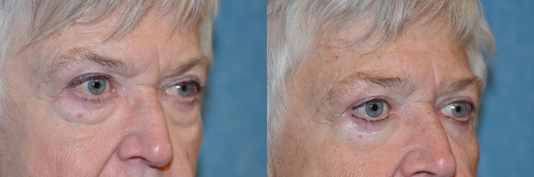 Before & After Eyelid Lift Case 251 View #2 View in Toledo, Ohio