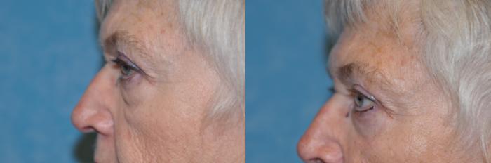 Before & After Eyelid Lift Case 251 View #3 View in Toledo, Ohio