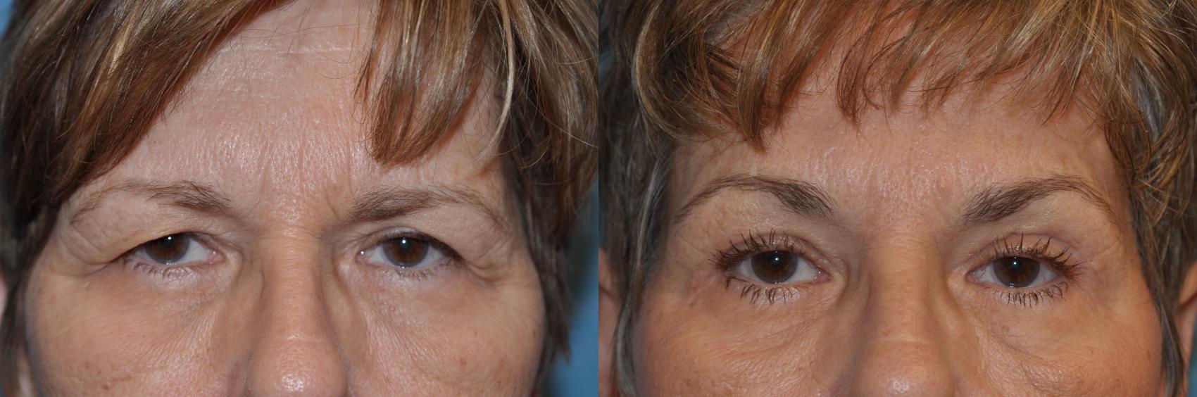 Before & After Eyelid Lift Case 285 View #1 View in Toledo, Ohio